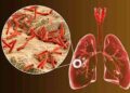 Mengenal Penyakit TBC dan Cara Pengobatannya